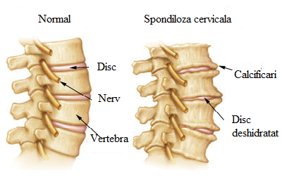 Boli degenerative articulare la nivelul coloanei vertebrale cervicale