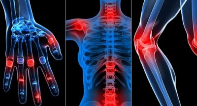 boli reumatice inflamatorii artroza tratamentul articulației genunchiului în stadiul 3